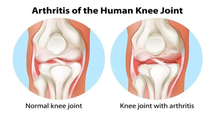 Arthritis Top Tips: Considering Joint Replacement Therapy