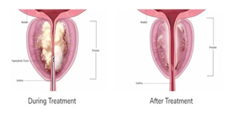 My husband has had prostate surgery. He can't have sex and still has the urge. It's hard work to accomodate him & painful for me.