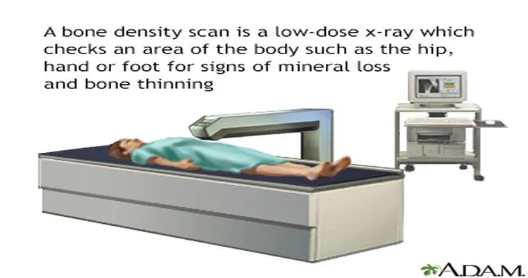 What is a DEXA bone density test?