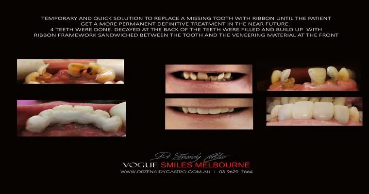 I need ideas for adjusting to permanent dentures, or learning how to live without teeth?