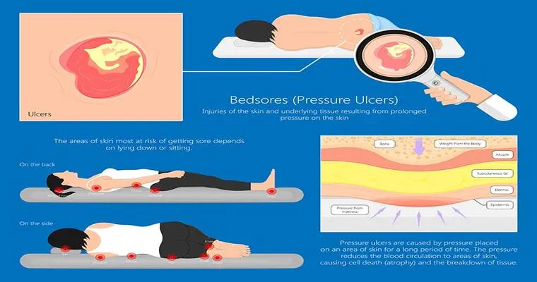 What Every Caregiver Should Know About Bed Sores