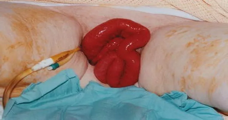 Blood in vagina, years after hysterectomy. What could cause this?