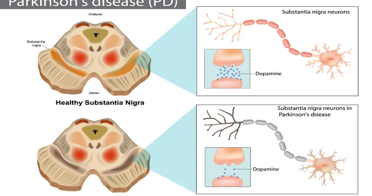 The Stages of Parkinson’s Disease