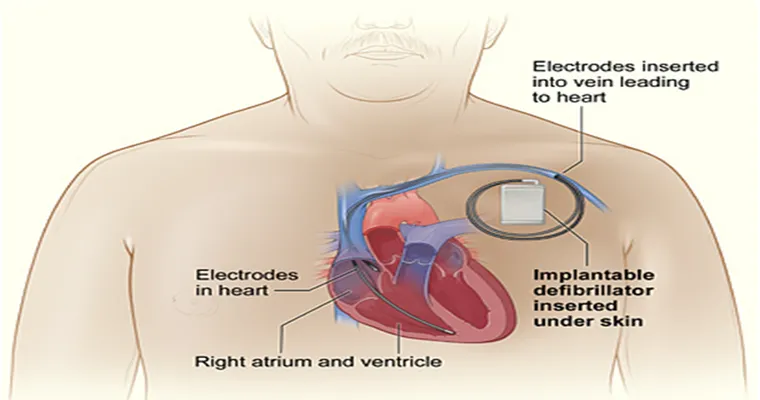Does anyone have experience making a decision about turning off an ICD (Implanted defibrillator) off on their hospice loved one?