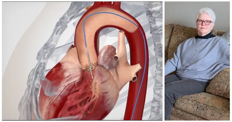 Advice on what to recommend to my dad regarding a Transcatherer Aortic Valve Implantation.
