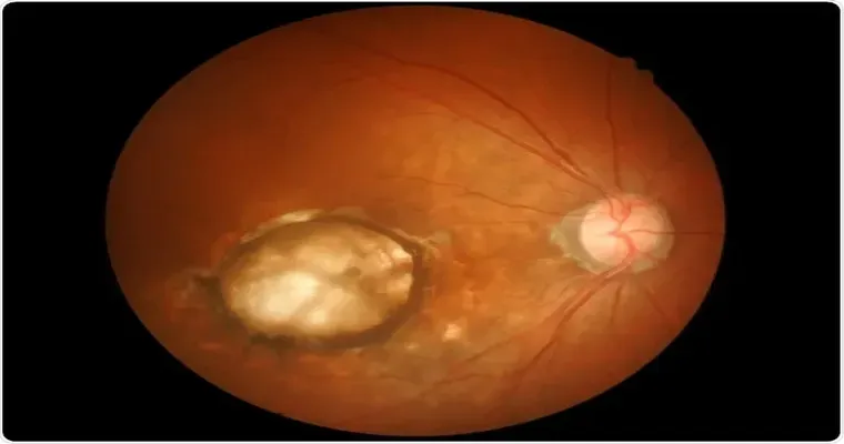 Study Reveals a Gene That Causes Age-Related Macular Degeneration