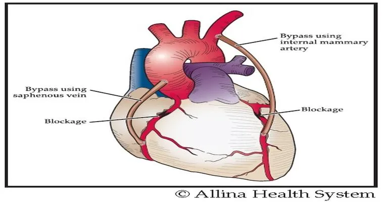 What Is Coronary Artery Bypass Grafting?