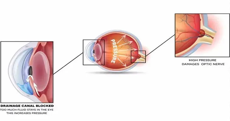 How Glaucoma Is Diagnosed and Treated