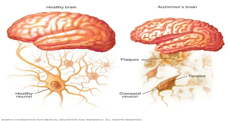 Why Do People Die From Alzheimer’s Disease?