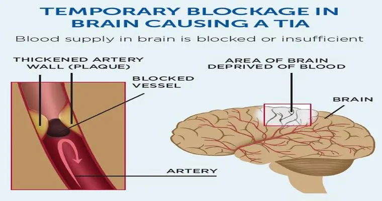 ‘Mini Strokes’ Can Have Mega Health Effects