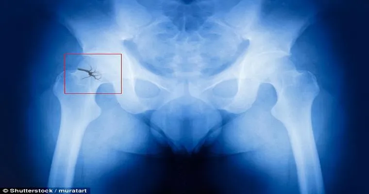 Mom Falls and Breaks OTHER hip!