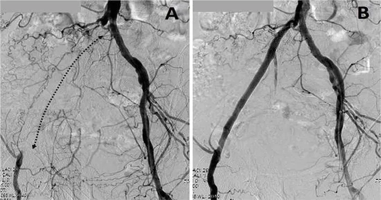 My mother has peripheral artery disease with severe occlusion. Angiogram has been recommended; should we put her through this procedure?