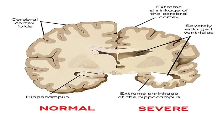 How Alzheimer’s Disease Affects the Brain