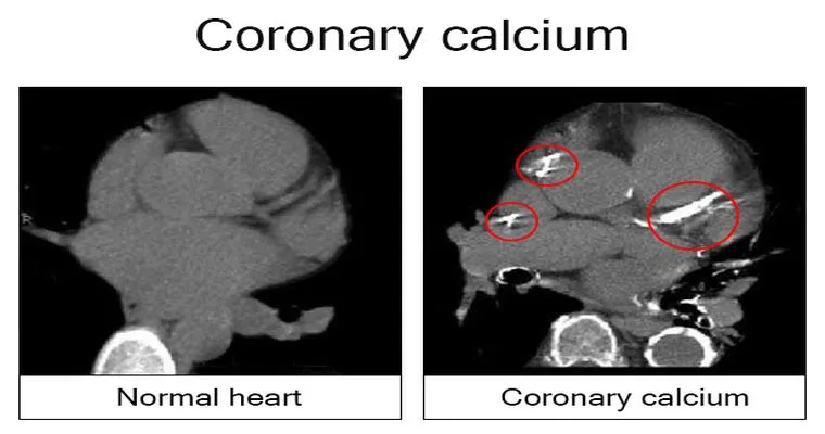 Has anyone ever done a coronary calcium score test?