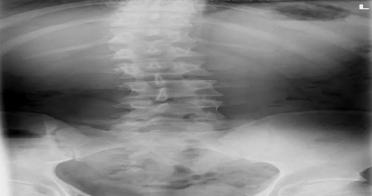 Anyone have experience with cracked vertebrae (spine bones) due to a fall for 83 year old? Which is best: brace or surgery?