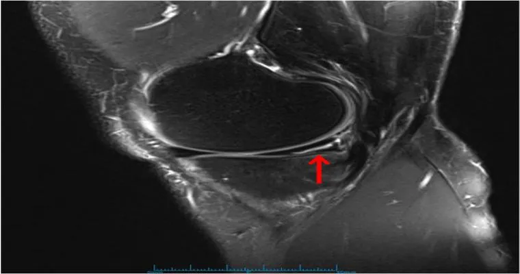 What is a reasonable solution to a complex tear of the medial meniscus?
