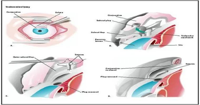 Glaucoma at 91 and she refuses eye drops. Dr. proposes surgery, but I don't see her cooperating. What should I do?