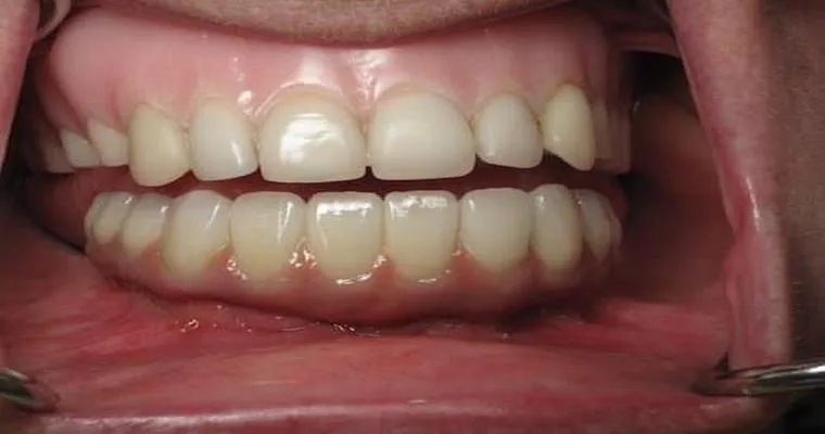 My 67 year old hubby won’t wear his false teeth!