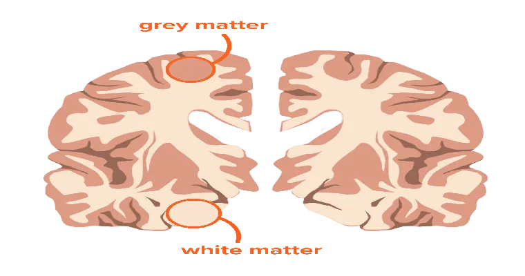 What Is Vascular Dementia?