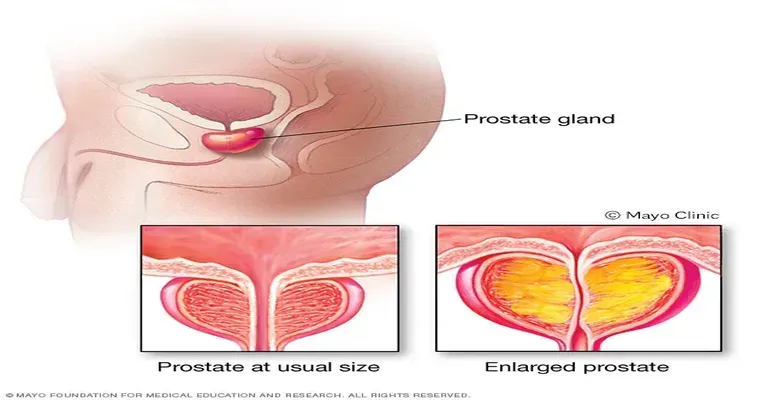 Prostate Problems in Elderly Men
