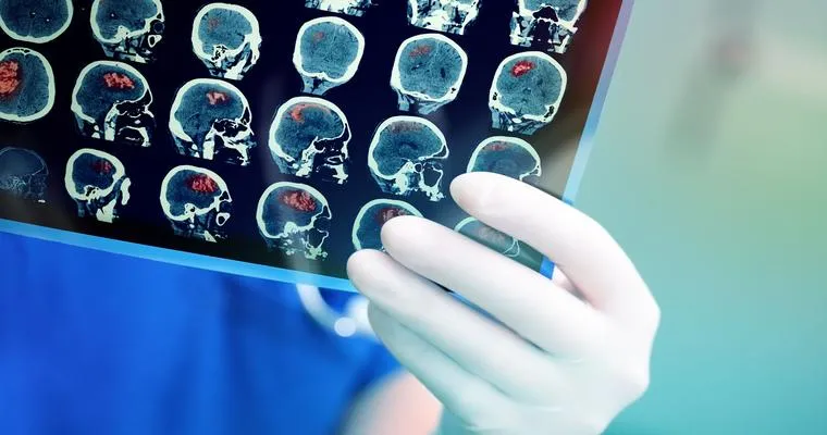 The Latest Research on Strokes