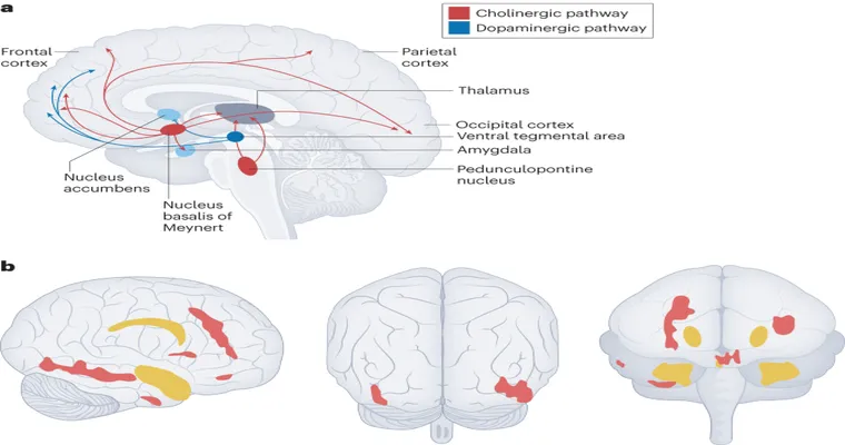Parkinson's Psychosis: A Little-Known Symptom of PD