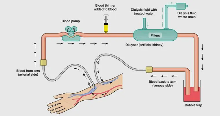 Dialysis for Kidney Failure