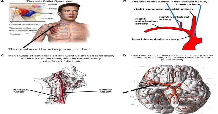 Stroke Recovery: Getting Back on Track