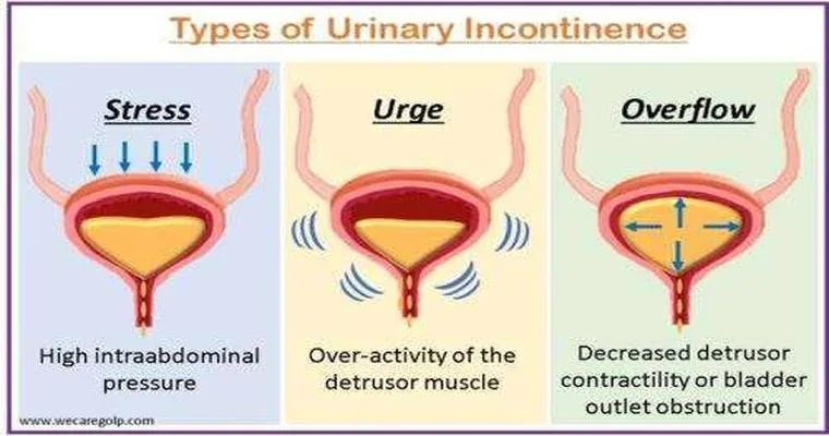The 4 Kinds of Urinary Incontinence
