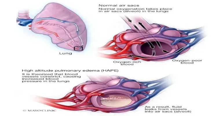 I have a question about fluid in lungs [pulmonary edema] in a patient with advanced dementia. I would like to ask about your experiences.