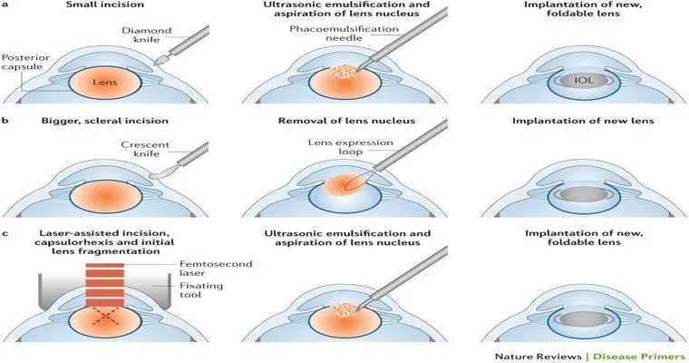 Treating Cataracts May Slow Cognitive Decline