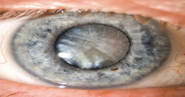 Cataract surgery issues.