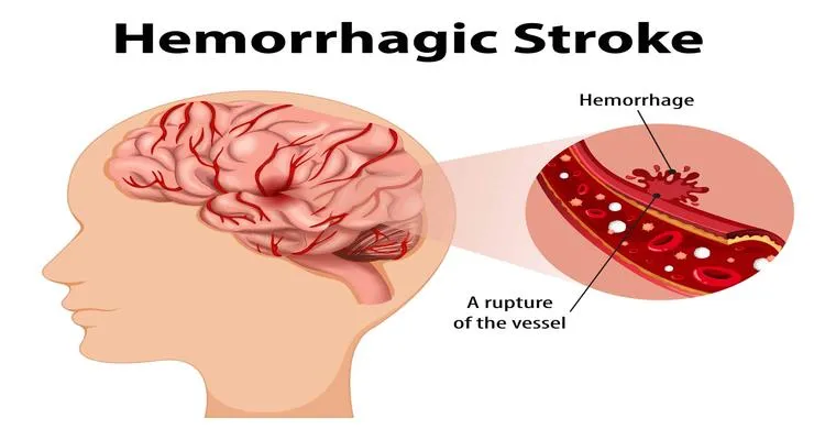 Hemorrhagic Strokes in Seniors
