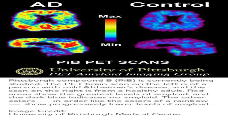 Medical Tests Used to Diagnose Alzheimer’s Disease