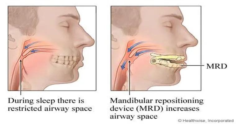 Treating Sleep Apnea Without a CPAP Machine