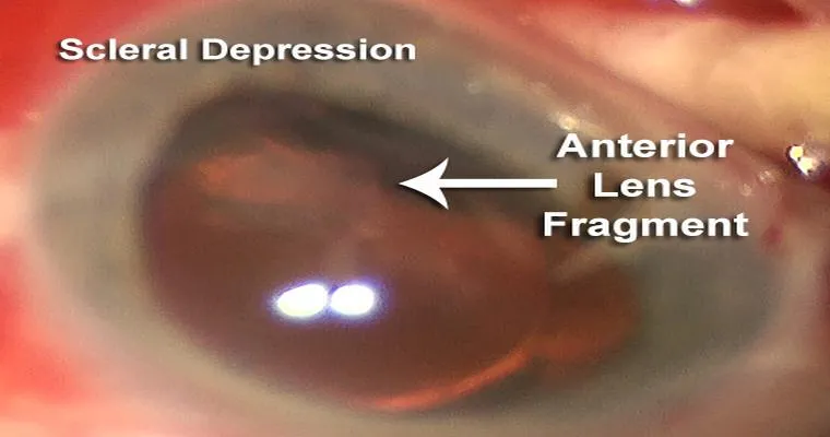 Are retained fragments of the lens a common risk in cataract surgery?