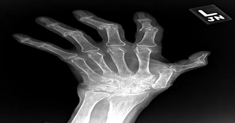 Erosive osteoarthritis?