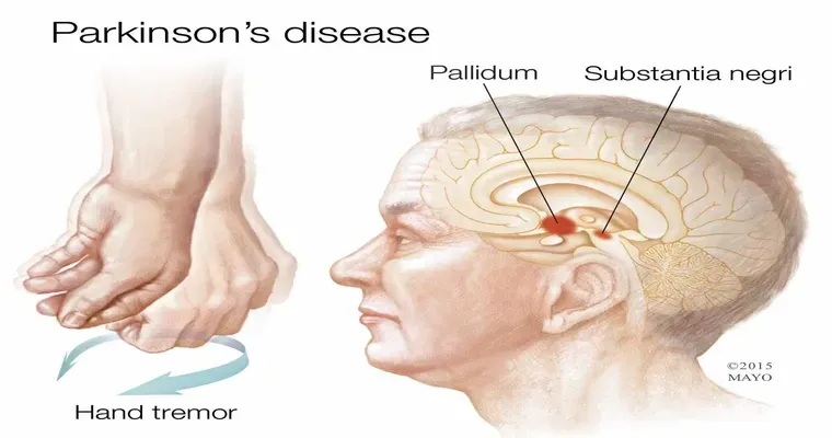 How Long Can a Person Live With Parkinson’s Disease?