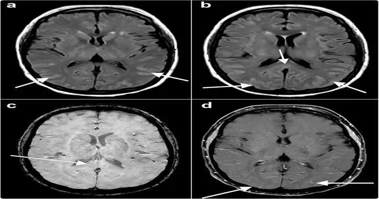 Delirium as Reaction to COVID Booster.