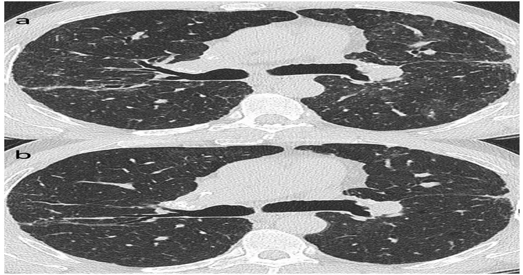 Ct scan shows COPD, end stage sarcoidosis, bronchiectasis, lots of inflammation throughout both lungs. What does this mean?
