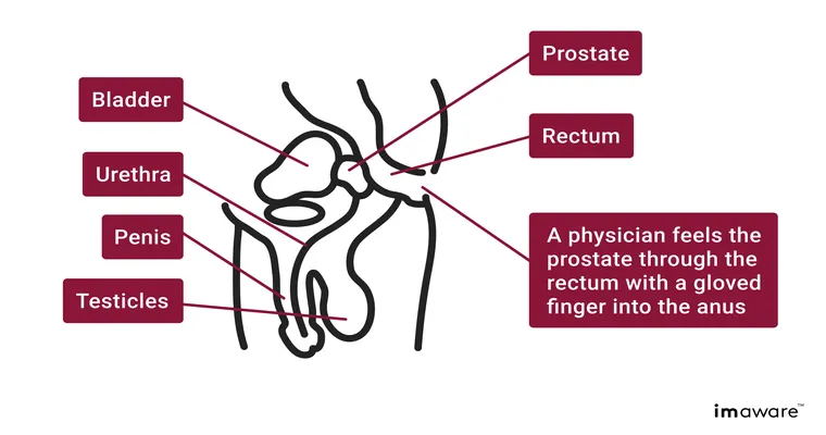 How to test prostate in men with dementia?