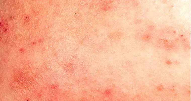 Skin Problems in the Elderly