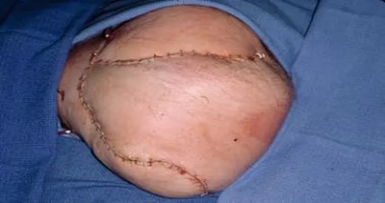 Are stage 3 bedsores ever “normal” and seemingly ok to have?