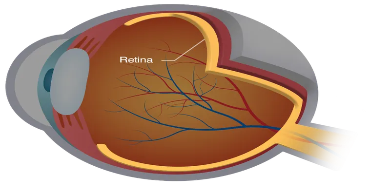 Eye problems - retina detachment and macula problems