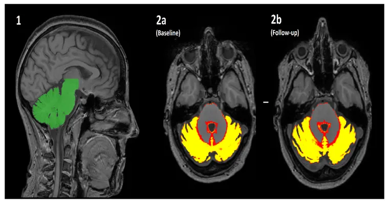 How to get someone to follow through with the advice of their neurologist? Especially the brain MRI.
