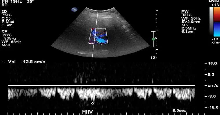 Hepatofugal flow.