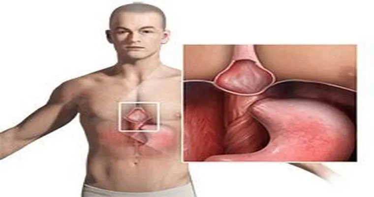 Hiatal hernia emergency.