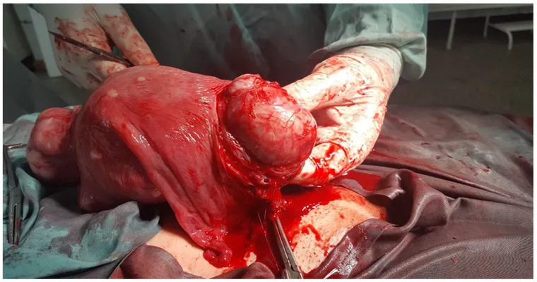 I had a full hysterectomy 20 years ago. Today at 61-years-old, I'm bleeding. What could cause this?