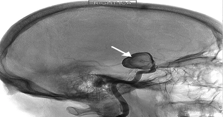 How are Strokes Diagnosed and Treated?