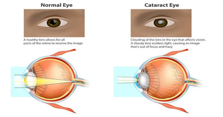 Cataract care mandatory? Wonder about elders having such surgery who likely may not live ten years or have other issues (like wet AMD).